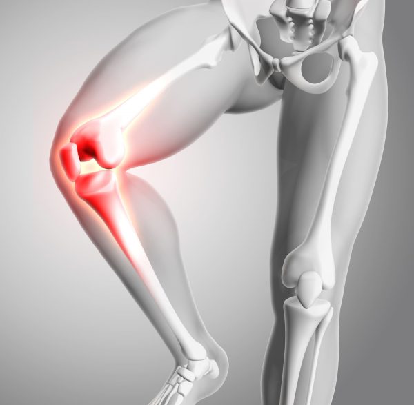 lesion de menisco y lca lesion de menisco y ligamento cruzado anterior fisioterapia menisco y lca