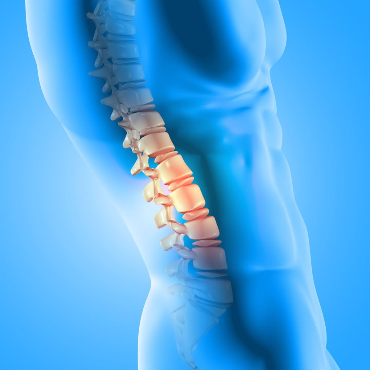 Hernia-disco Hernia de Disco Lumbar ejercicios hernia de disco lumbar tratamiento hernia de disco lumbar fisioterapia hernia de disco lumbar