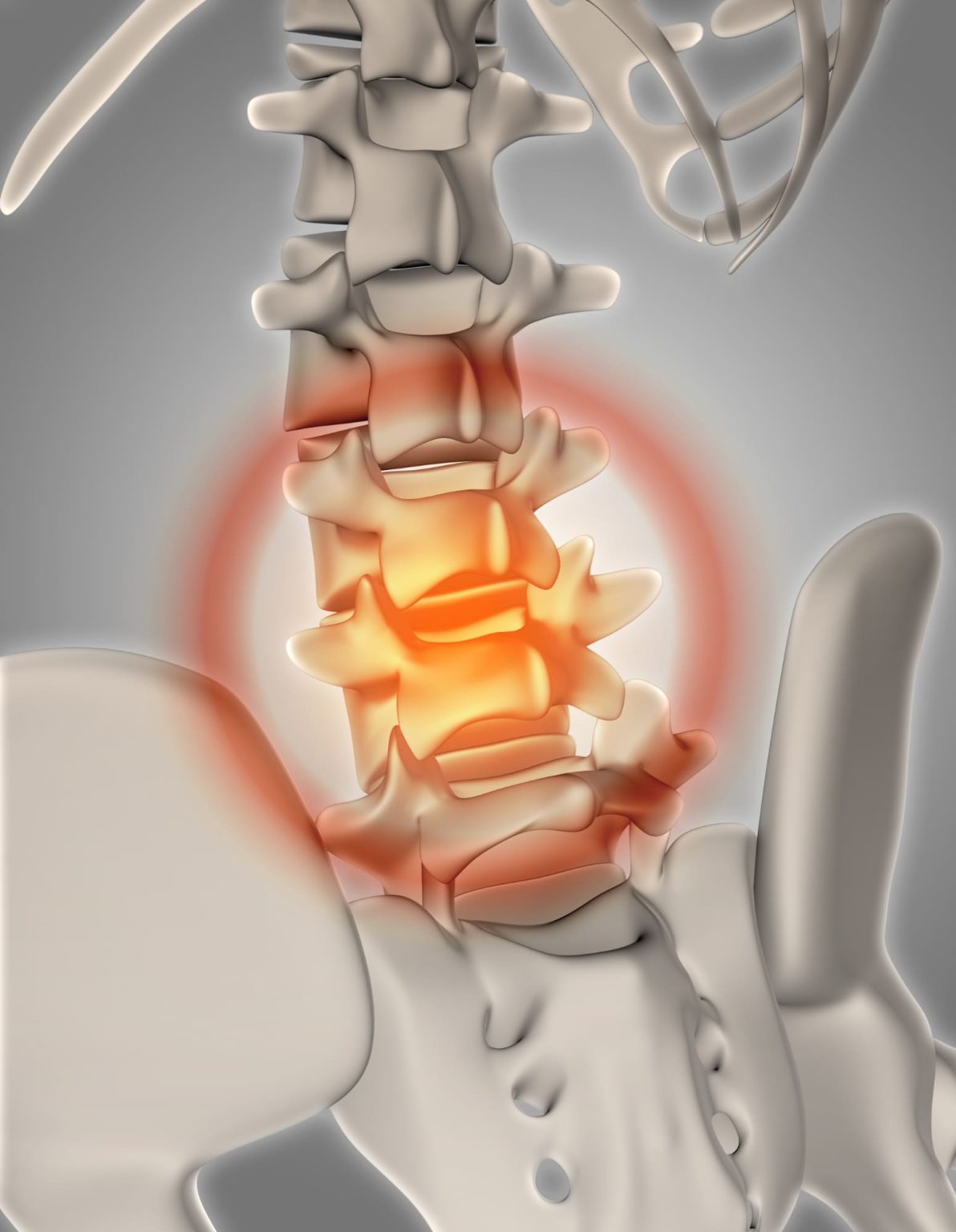 Hernia-disco Hernia de Disco Lumbar ejercicios hernia de disco lumbar tratamiento hernia de disco lumbar fisioterapia hernia de disco lumbar