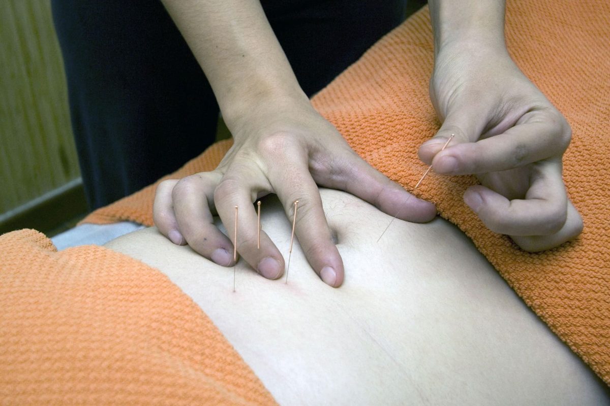 acupuntura tratamiento acupuntura